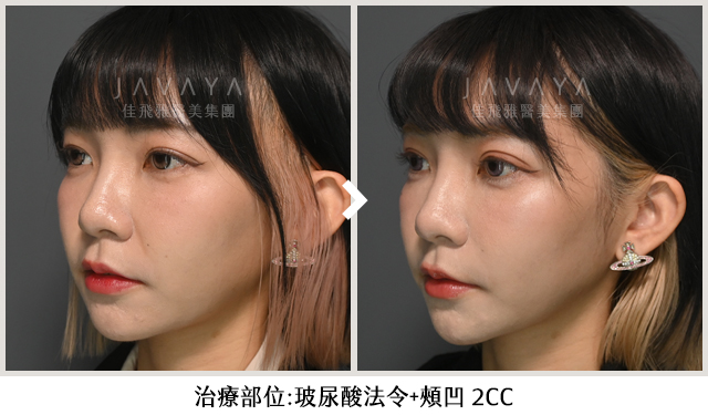 柔和順眼的自然蛻變：女神玻尿酸OBT 2CC帶來的視覺驚豔-Before&After（側面）｜案例見證-安夏Mika